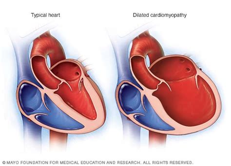 lv dilatation|cardiomegaly with biventricular dilatation.